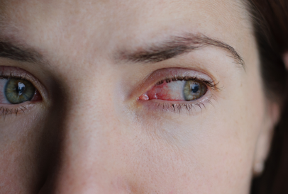 ¿Qué es el ojo rojo?